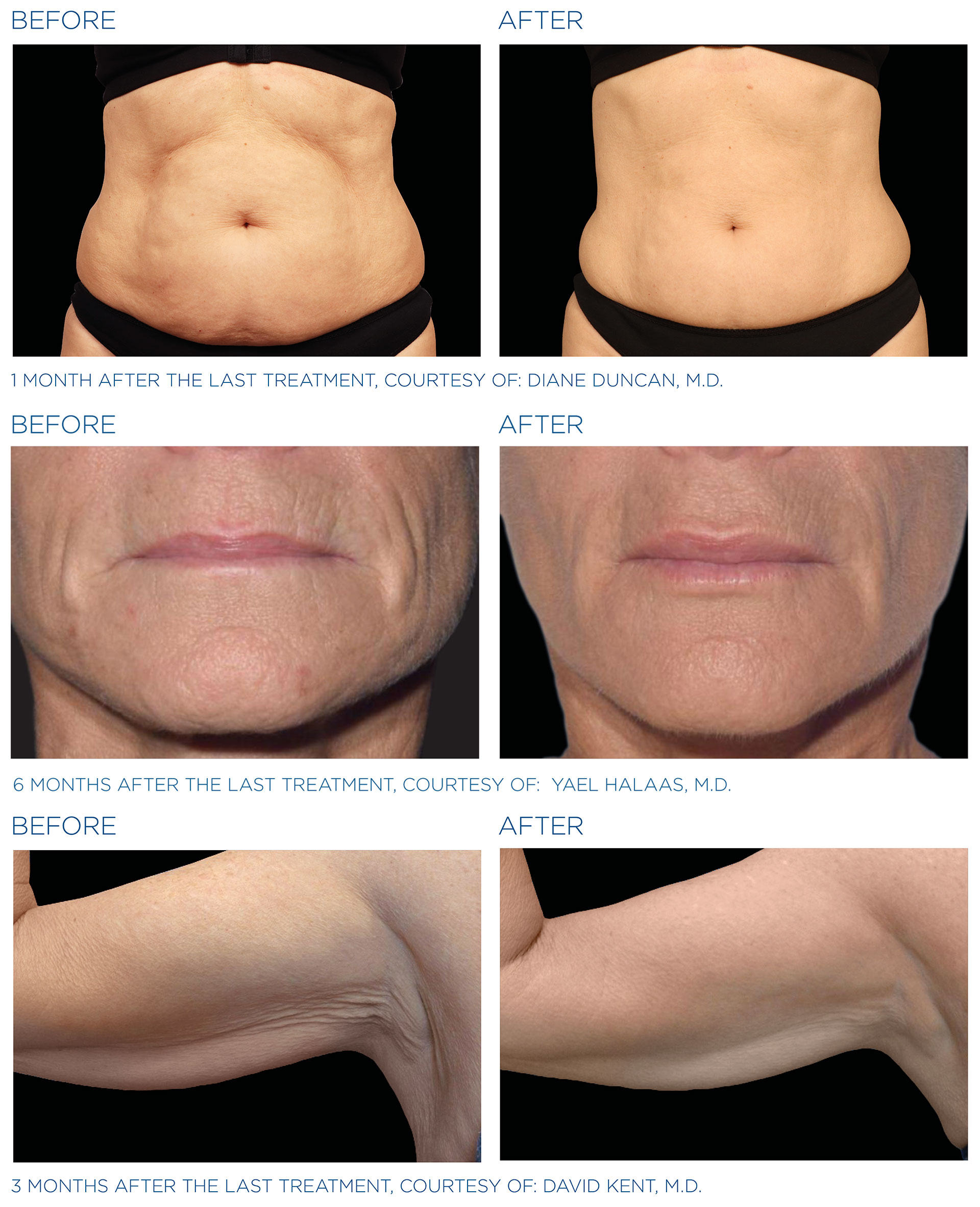 Non-surgical skin rejuvenation before and after