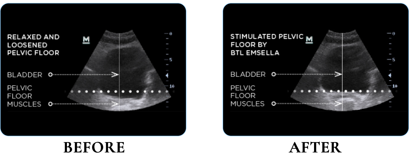 EMSELLA before and after