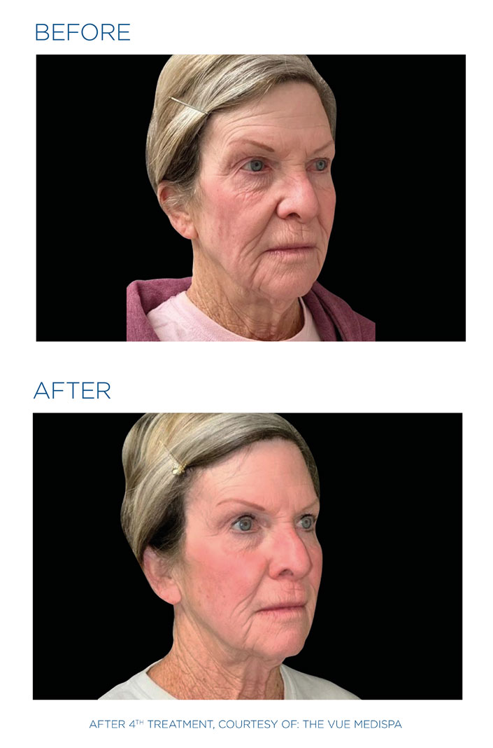 EXION before and after